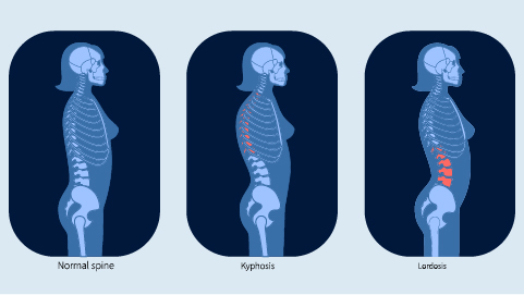 An animated image of a normal spine, Kyphosis, and Lardosis.