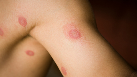 An image of a person with ringworm on their arm and chest.