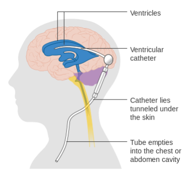 Diagram showing a brain shunt