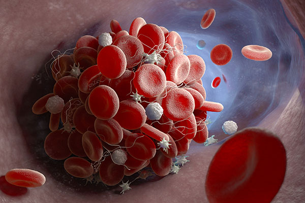 Illustration of red blood cells clotting together inside the human body