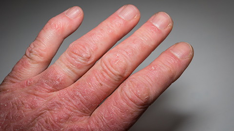 Closeup of a man's hand with arthritis