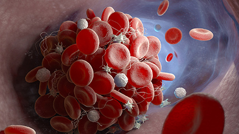 Red and white blood cells forming a clot inside an artery