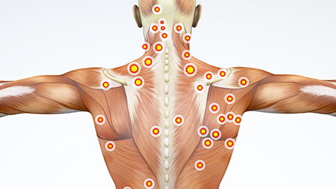 Anatomical image of muscles on a back showing multiple trigger points