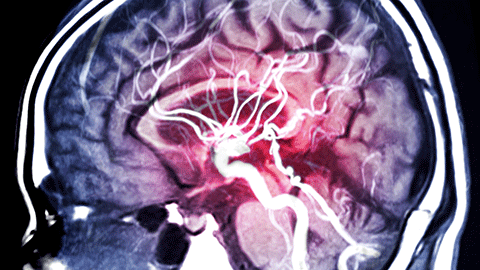 Illustration of a brain scan during a stroke