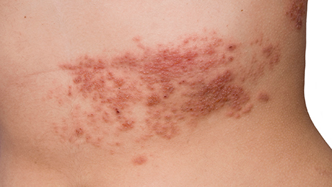 Red and bumpy shingles rash on a person's back