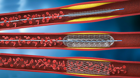 Digital illustration of three types of stents inside human arteries.
