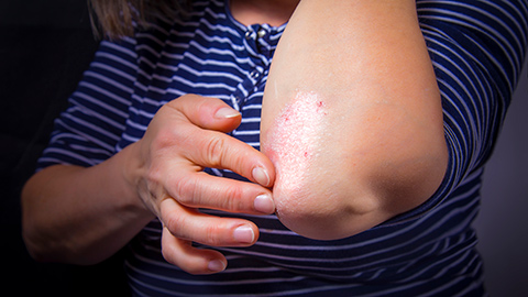 A woman touches her bent elbow to reveal her psoriasis condition.