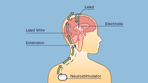 An animated image of deep brain stimulation showing the neurostimulator pathways.