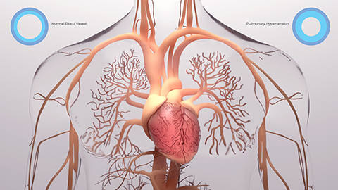 A 3-D animated image of the venous system with pulmonary arterial hypertension.