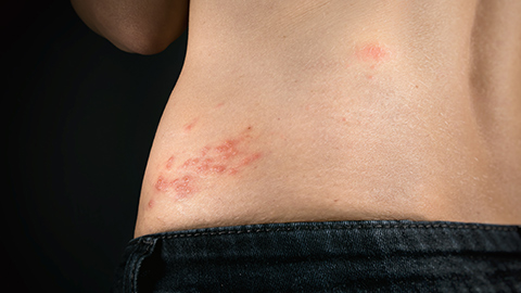 An image of a person with a shingles outbreak on their lower back.