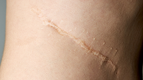 An image of a post-surgical scar located on the back.