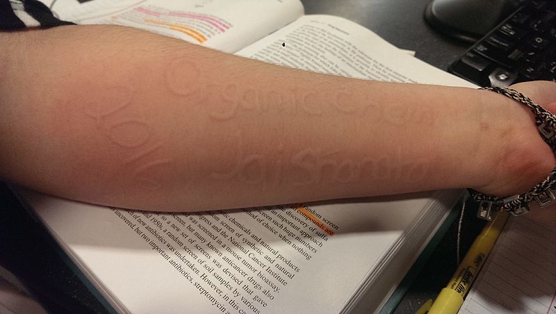 Dermatographism on forearm of a 19 year old college student.