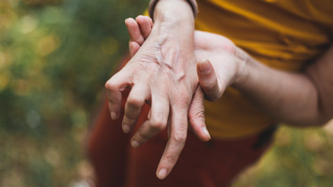 A woman’s hand with the fingers twisted and swollen from lupus.