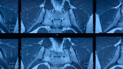 X-ray of a person with ankylosing spondylitis.