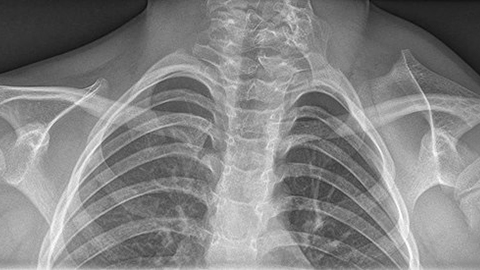 An X-ray image of the chest and shoulders showing sprengel's deformation.