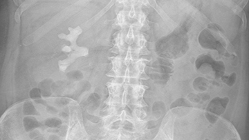 An X-ray image of a kidney stone.