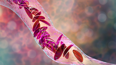 A computer animated image of sickle cell disease.