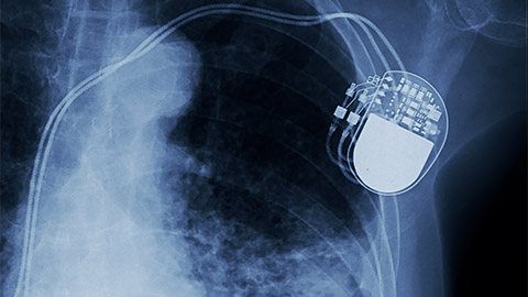 An x-ray image of a pacemaker in the human body.