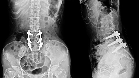 X-ray of spine showing a lumbar fusion 
