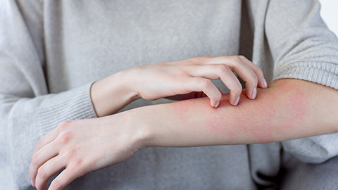 Woman scratching forearm while having an allergic reaction with hives.