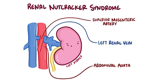 Hand-drawn illustration of how kidneys are affected by nutcracker syndrome.