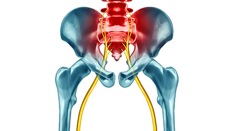 Anatomical illustration of lower back and sciatic area highlighted red