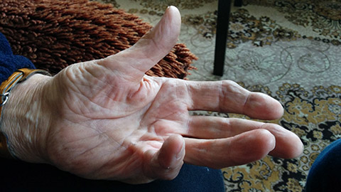 Elderly hand twisted and contorted by Dupuytren’s contracture.